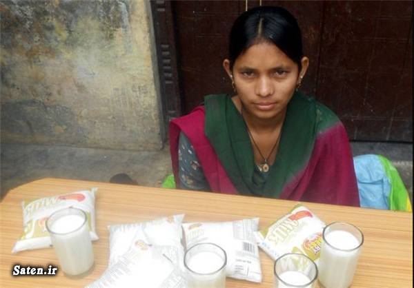 زن هندی درمان آشالازی دختر هندی بیماری عجیب بیماری آشالازی انسان عجیب