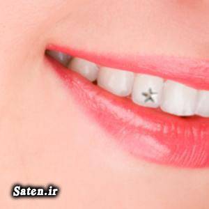 نگین دندان مجله سلامت مجله پزشکی زیبایی دندان پیشگیری از پوسیدگی دندان بهداشت دهان و دندان