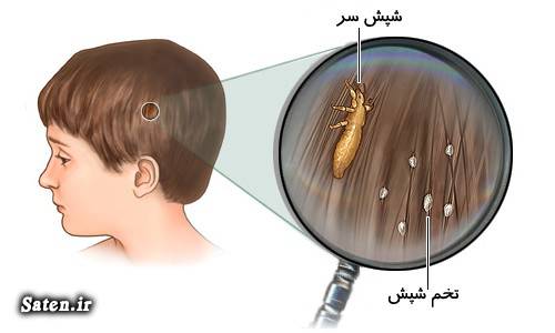 علائم شپش سر طب سنتی شامپو ضد شپش درمان شپش سر درمان خانگی بیماری شپش بهترین شامپو head louse