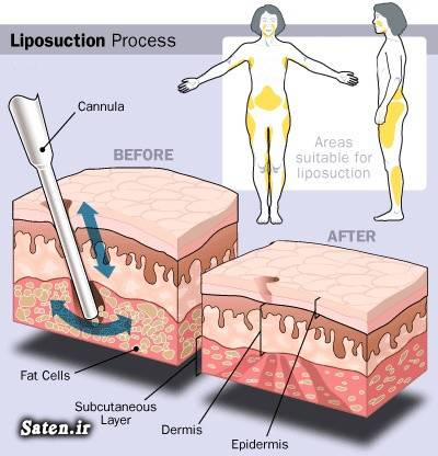 هزینه لیپوساکشن هزینه جراحی زیبایی لیپوساکشن چربی شکم چربی باسن جراحی زیبایی انواع جراحی زیبایی liposuction