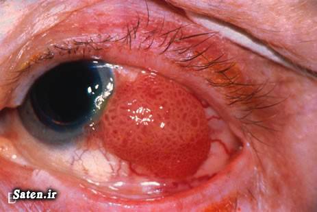 ملانوما مجله پزشکی متخصص چشم پزشکی علت سرطان چشم عکس سرطان چشم سندروم چشم رتینوبلاستوم درمان سرطان چشم پیشگیری از سرطان Eye neoplasm