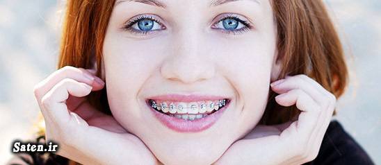هزینه و تعرفه های دندانپزشکی هزینه ارتودنسی بهداشت دهان و دندان ارتودنسی قبل و بعد