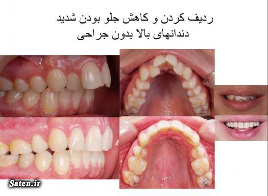 هزینه ارتودنسی چقدر است؟ آیا به قیمت از دست رفتن سلامتی می ارزد؟ golestan