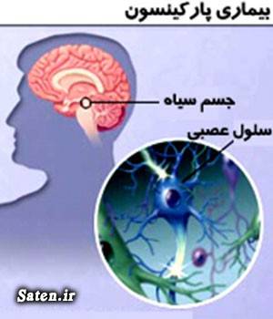 مجله پزشکی متخصص مغز و اعصاب عمل جراحی پارکینسون طب سنتی دکتر منصور پرورش درمان پارکینسون پارکینسون طب سنتی Parkinson