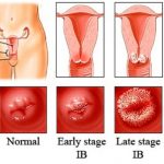 hpv چیست؟ hpv چه علائم و نشانه هایی دارد؟ +عکس HPV چیست, بیماری های آمیزشی, بیماری های جنسی, تشخیص زگیل تناسلی, خطرناکترین بیماریهای مقاربتی, درمان بیماری HPV, درمان زگیل تناسلی, راههای انتقال زگیل تناسلی, راههای انتقال ویروس hpv, علائم hpv, مجله سلامت, ویروس hpv در دهان, ویروس زگیل تناسلی