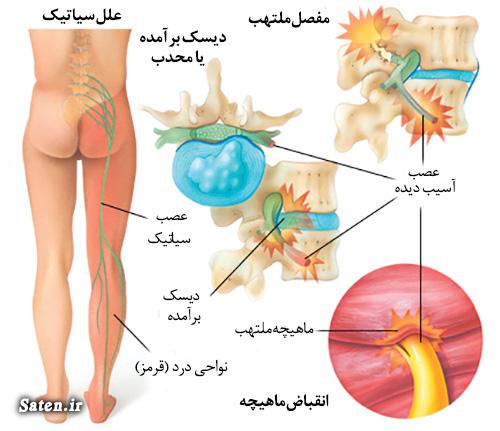 سیاتیک چیست سیاتیک رگ سیاتیک درد سیاتیک چگونه است